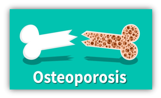 Read more about the article Osteoporosis